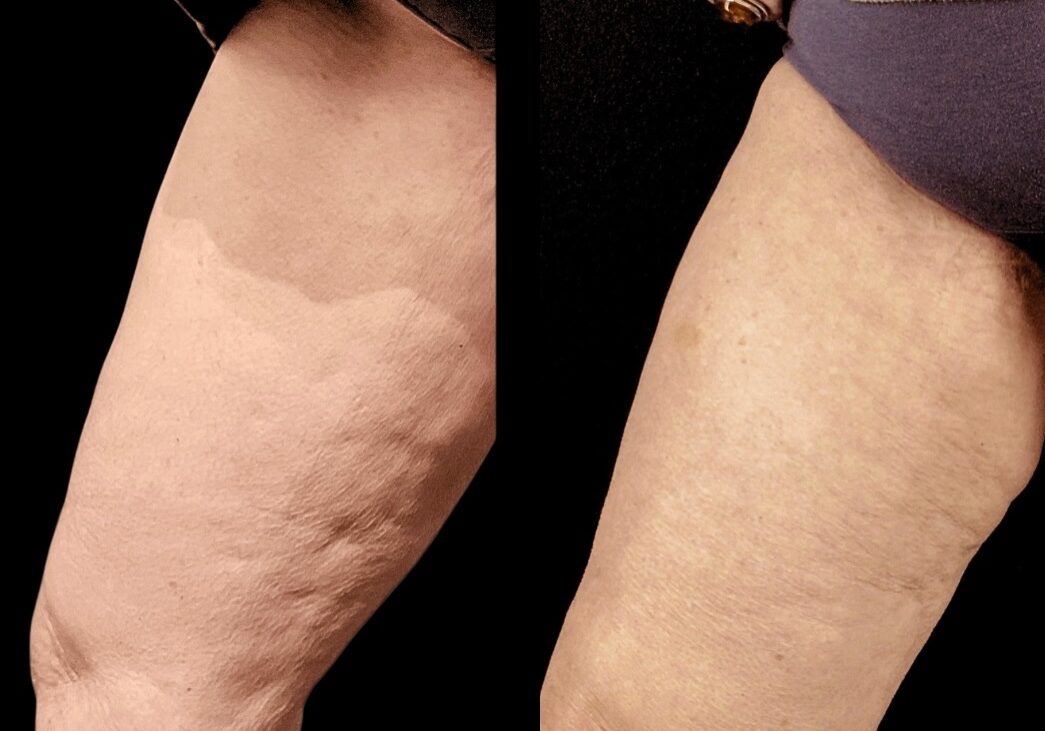 Cellulite 5