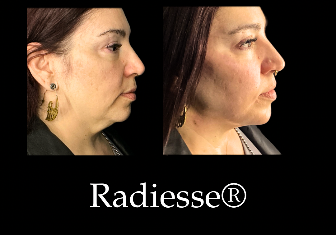 Radiesse Results 4